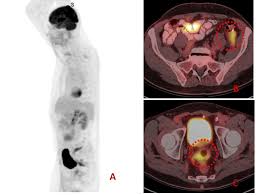 The doctor may order a ct scan for further evaluation. Cureus Malignant Peritoneal Mesothelioma Mimicking Recurrent Diverticulitis