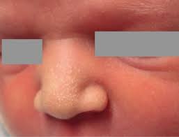 They are generally followed by branny desquamation of the cuticle in the position they have occupied. Neonatal Skin Disorders Springerlink