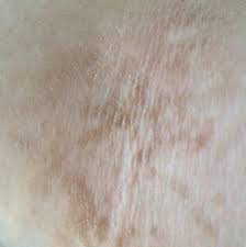 Braune Flecken Auf Haut