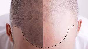 Does Metformin Cause Hair Loss Or Thinning Guide 2021