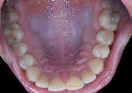 Mouth cancer is one of the common form of cancer in india and south eastern countries. Why Is The Roof Of My Mouth Sore Glen Dental