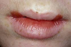 Herpes simplex virus two further conditions, seen especially in children, are herpetic gingivostomatitis and herpetic whitlow. How Do I Manage A Patient With Recurrent Herpes Simplex Jcda