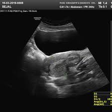 A pelvic ultrasound is a test that uses sound waves to make pictures of the organs inside your pelvis. Abdopelvic Ultrasonography Pearl Sonography