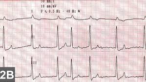 We'll give you five different methods and an easy way to determine your target heart rate. Top 5 Arrhythmias In Dogs Cats Clinician S Brief