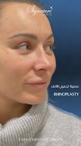 عملية تجميل الأنف مع د. إيلي أيوب ✨, لأنف مثالي وملامح متناسقة!,  ‏Rhinoplasty with Dr. Elie Ayoub ✨, ‏For a perfect nose and balanced  features!, Free consultation , Book Now:, Dubai:+971566177757, ...