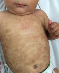 Image result for Urticaria pigmentosa children