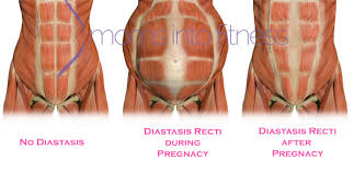 It's especially common in pregnant women because of the strain placed on the abdomen by the growing baby.2 x research source however, with a few. Prenatal Core Exercises To Help Prevent Diastasis Recti The Balance Method