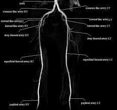 Upper part of the ischial tuberosity insertion: Upper Legs Arteries Mra Upper Legs Arteries Anatomy Thigh Arteries