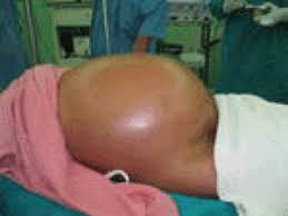 But there are many other reasons that could cause you to bloat. Ovarian Cancer Ascites Vs Belly Fat Telling The Difference Scary Symptoms