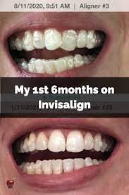My 1st 6 Months On Invisalign In 2021 Invisalign 6 Months Months