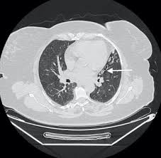 Image result for Broncholithiasis