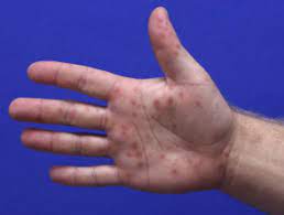 Hand, foot, and mouth, also called coxsackie virus, is an infection caused by the enterovirus. Hand Foot And Mouth Disease Dermnet Nz