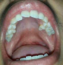 Normal roof of mouth photos. Healthy Healthy Roof Of Mouth Images