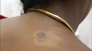 Image result for polymorphous eruption