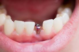 Image result for dental implant