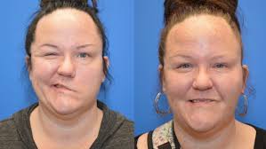 A surgical error by a doctor in another city paralyzed half of Mandy  Gartner's face. She could no longer smile and was in danger of losing sight  in her left eye. But Nebraska Medicine plastic and ...