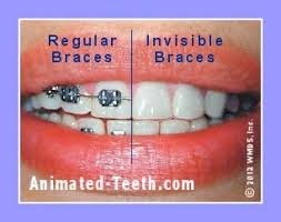 Private braces cost £1,500 to £5,000 for most people, with the average cost of metal braces for adults around £2,000 to £3,000. Comparing Costs Invisalign Express Vs Other Kinds Of Braces