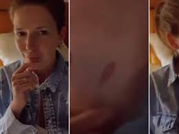 Isabel Macedo sufrió un accidente doméstico que le dejó una quemadura: “No  es un chupón”