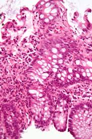 Virtual care can help you manage and treat ibd. Inflammatory Bowel Disease Wikipedia