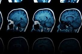 For example, if a brain tumor is located in the cerebellum at the back of the head, a child may have trouble with movement, walking, balance and coordination. Brain Tumors In Children Symptoms Diagnosis And Treatment