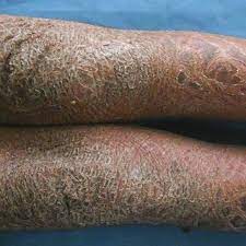 Pdf Sjogren Larsson Syndrome A Study Of Clinical Symptoms In Six Children