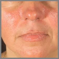 Image result for Photodermatitis