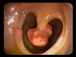Image result for Colonic Polyp