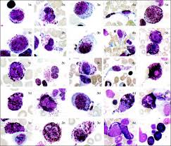 John Libbey Eurotext Annales De Biologie Clinique Mastocytoses Classification Diagnostic Biologique Et Traitement