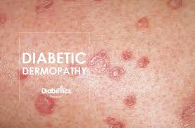 Diabetic Dermopathy An Overview Diabetes Blog In 2020 Diabetes Paw Print Paw Print Tattoo