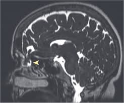 Pericarditis is inflammation of the pericardium (the fibrous sac surrounding the heart). Scanner Realites Biomedicales