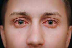 15 Causas De Ojos Rojos Al Despertar Y Como Aliviarlos