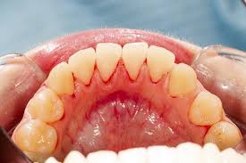 Check spelling or type a new query. Reversing Tooth Decay The Center For Cosmetic Dentistry Smithtown Long Island