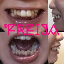 はじめに、まじめに。 | 歯列矯正、はじめました。おわりました。