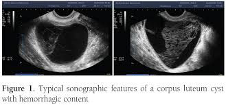 Image result for corpus luteum sonography)