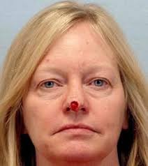 As the saying goes, eyes are the window to the soul, so it is important to keep them as sharp and clear as possible. Skin Cancer Reconstruction Photos Patient 1088 Results By Irvine Plastic Surgeon Dr Cory Yeh