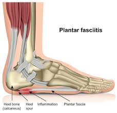 We will then go on to look at the different treatment options. Plantar Fasciitis Healthdirect