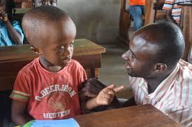 Image result for Hydrocephalus