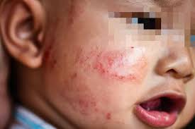 Lampin kering dalam masa 3. Kenal Pasti Alahan Anak Anda Dan Cara Mengatasinya Famili Mstar