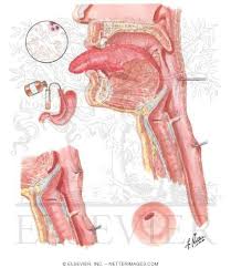 Plummer vinson syndrome (pvs) is a very rare disorder associated with chronic iron deficiency anaemia. Plummer Vinson Syndrome