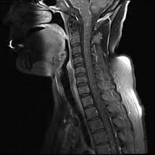 A brain magnetic resonance imaging (mri) showed multiple areas of minimal a crucial role in the diagnosis of clippers syndrome is preserved for mri imaging of the brain and spinal cord because. Chronic Lymphocytic Inflammation With Pontine Perivascular Enhancement Responsive To Steroids Clippers Radiology Reference Article Radiopaedia Org
