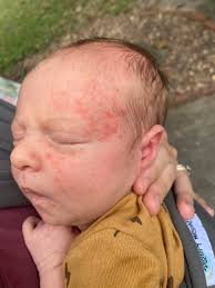 My baby is 6 months old, her little earring is infected .. went to the dr  and she gave me ointment ￼for it and said if it doesn't clear up in a