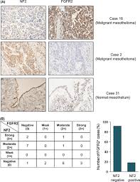 Malignant pleural mesothelioma is a highly aggressive tumor associated with asbestos exposure. Establishment And Characterization Of Crispr Cas9 Mediated Nf2 Human Mesothelial Cell Line Molecular Insight Into Fibroblast Growth Factor Receptor 2 In Malignant Pleural Mesothelioma Wahiduzzaman 2019 Cancer Science Wiley Online Library