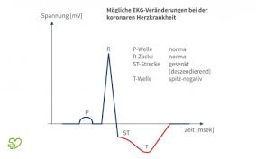 Angina Pectoris Und Koronare Herzkrankheit Symptome Ursachen Therapie Onmeda De