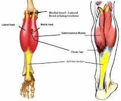 Along with the soleus muscle, the gastrocnemius forms half of the calf muscle. Medial Gastrocnemius Strain Causes Symptoms Diagnosis Treatment Prognosis