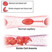 Sickle Cell Disease Wikipedia
