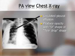 The pleural fluid may be classified as a transudate or an exudate, depending on the etiology. Diagnosing Pleural Effusion