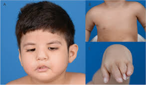 Poland-Möbius syndrome: a case report implicating a novel mutation of the  PLXND1 gene and literature review