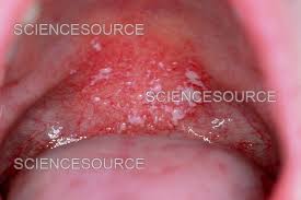 Image result for oral thrush symptoms roof of the mouth