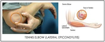 Tennis elbow is a common cause of chronic elbow pain. Tennis Elbow Dr Jonathan Lee Yi Liang