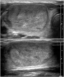 If no other malignant features (e.g. Plos One Large 3cm Thyroid Nodules With Benign Cytology Can Thyroid Imaging Reporting And Data System Tirads Help Predict False Negative Cytology
